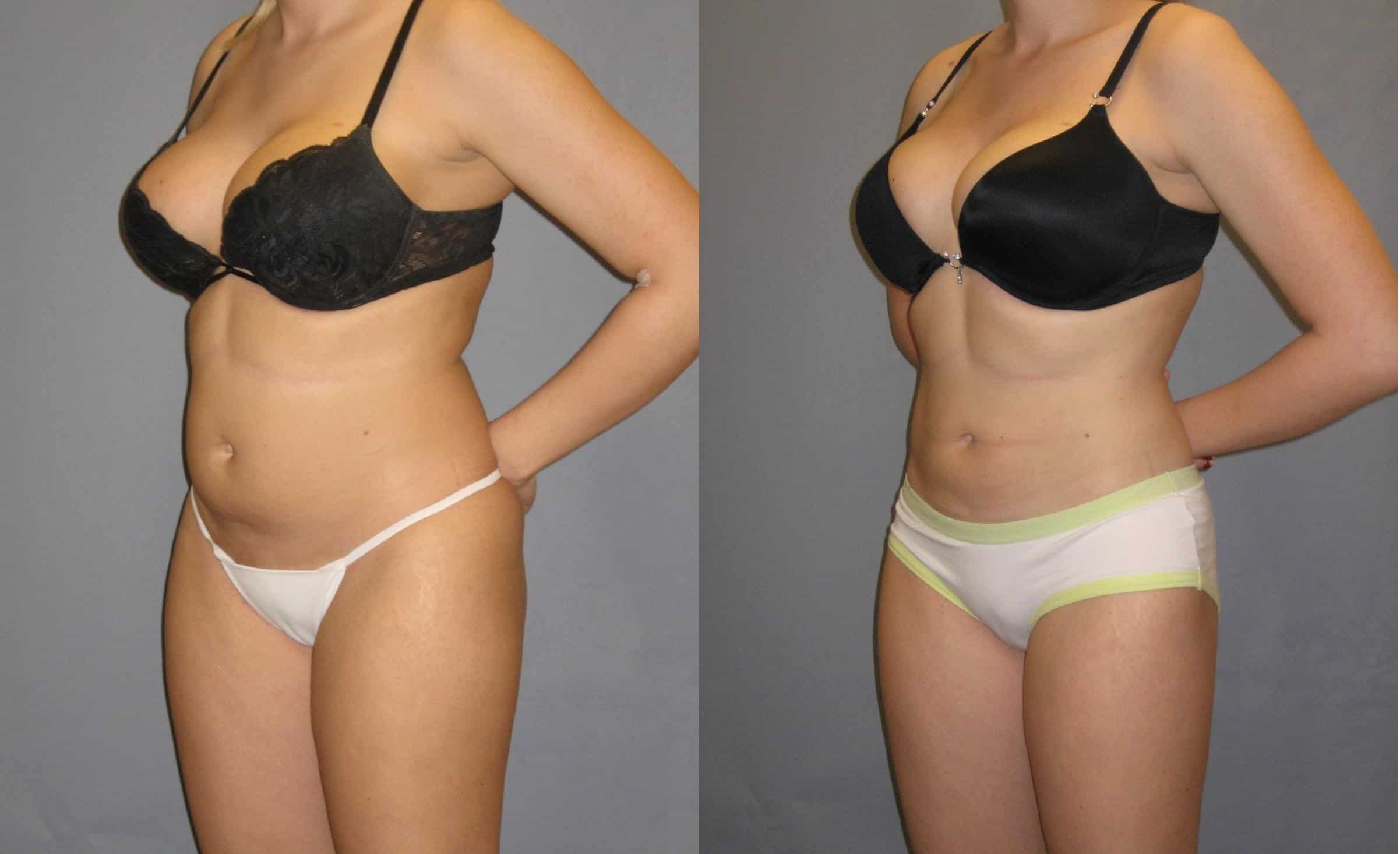 liposuction before after