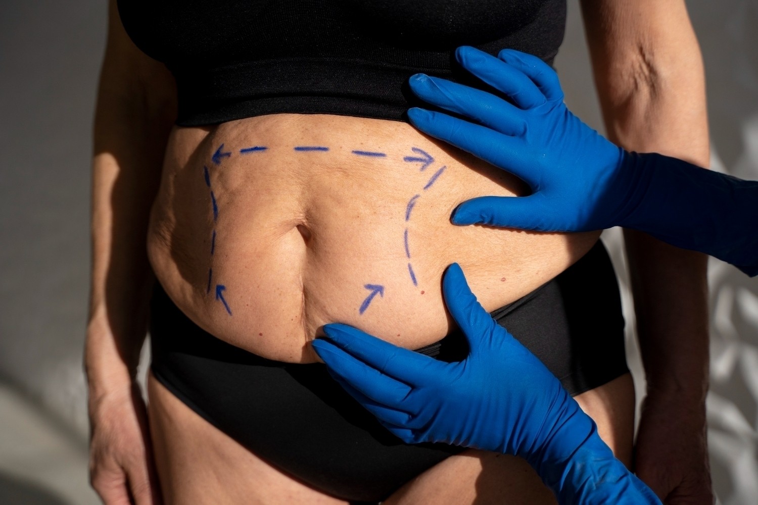 before liposuction