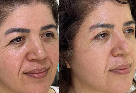 Blepharoplasty (Eyelid Surgery)