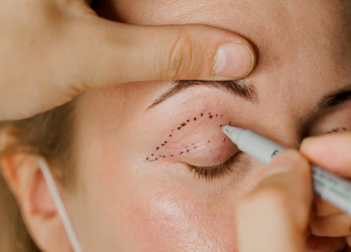 eyelid surgery