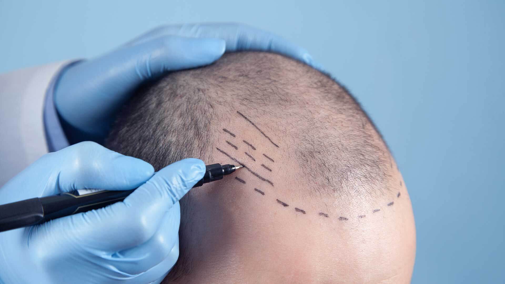 hair transplant