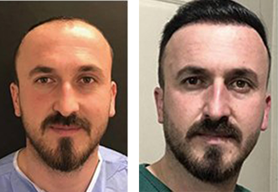 Hair Transplant