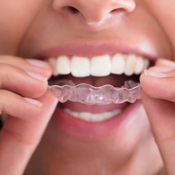 Invisalign