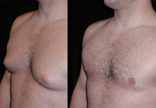 Gynecomastia