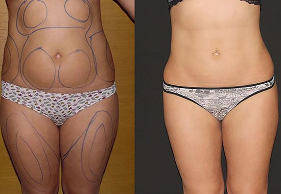 Liposuction