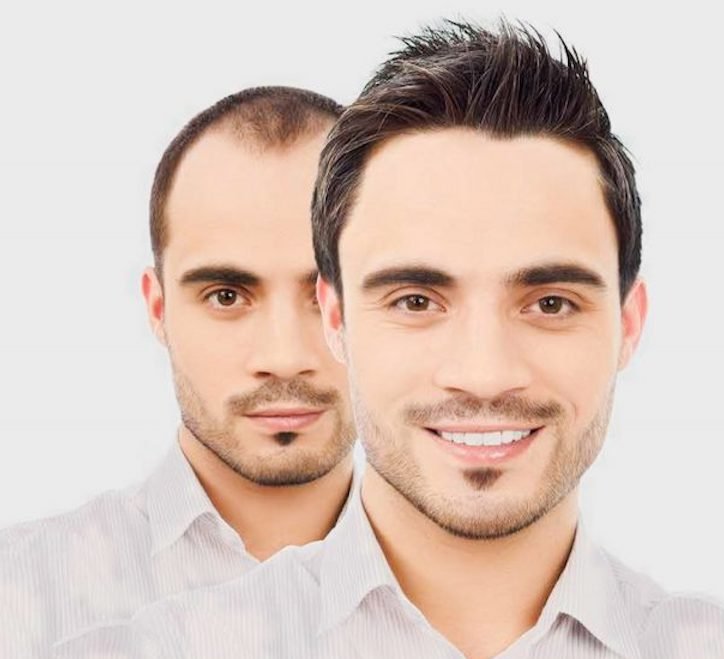 Hair Transplant