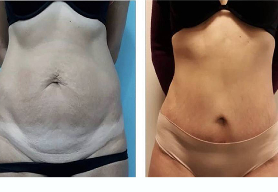 Tummy Tuck