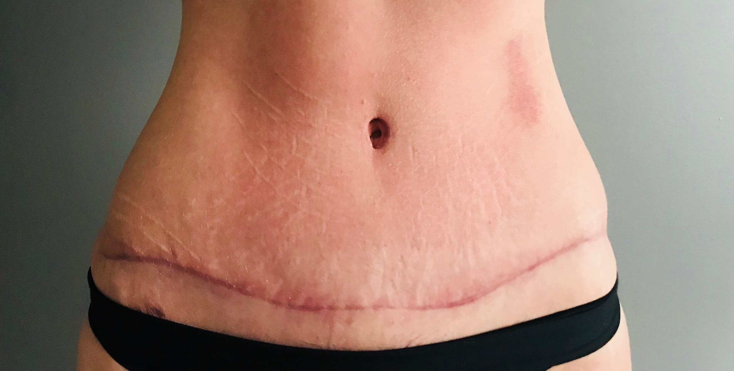 tummy tuck scar