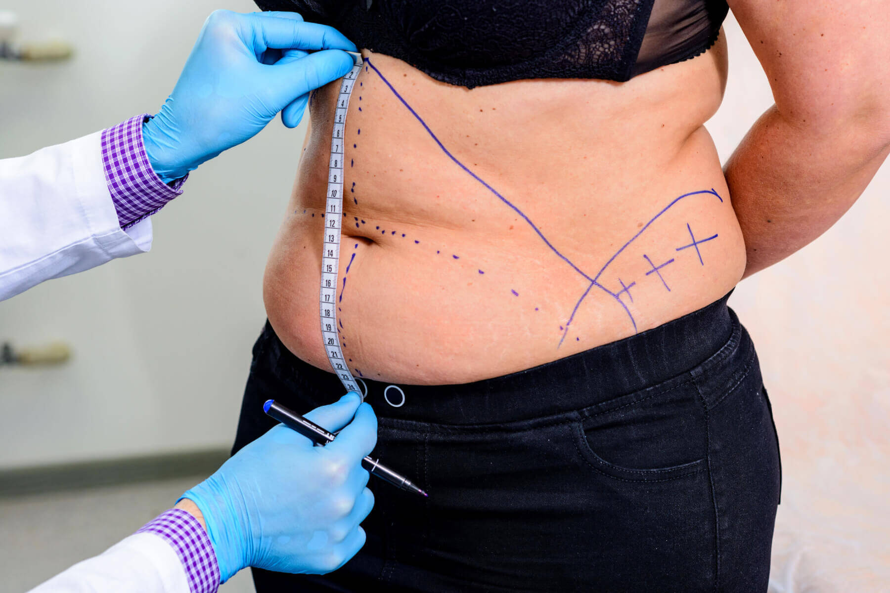 tummy tuck surgery