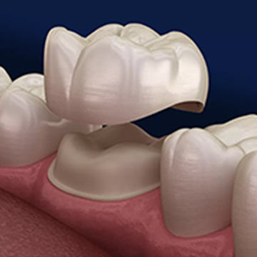 Dental Crowns