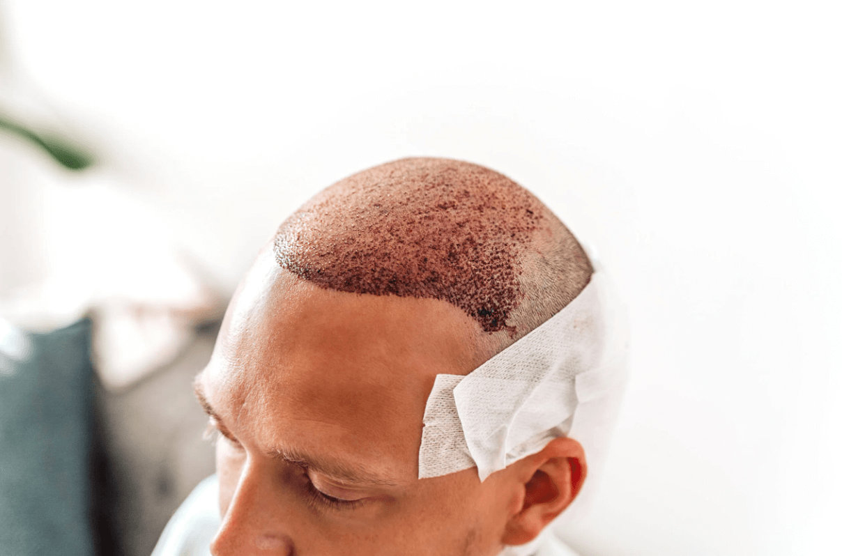 hair transplant