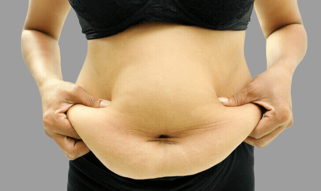 liposuction