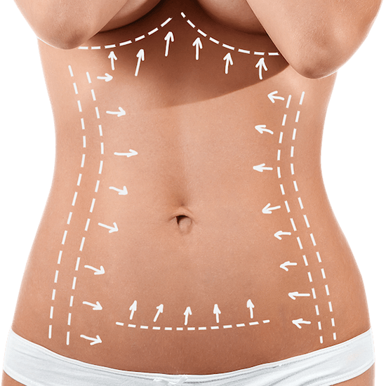 Tummy Tuck